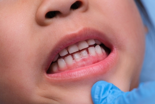 10 Cara Menjaga Kesehatan Gusi untuk Anak-anak