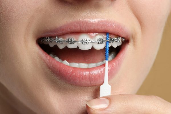 7 Tips Merawat Gigi Saat Menggunakan Behel 7 Tips Merawat Gigi Saat Menggunakan Behel
