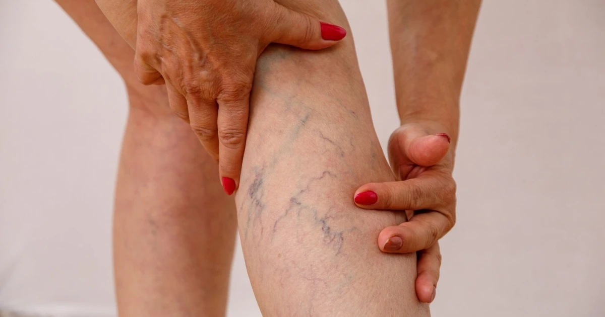 5 Langkah-Langkah Menghadapi Varises di Kaki
