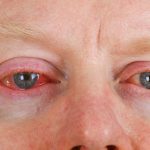 5 Tips Mengatasi Mata Merah Tanpa Obat